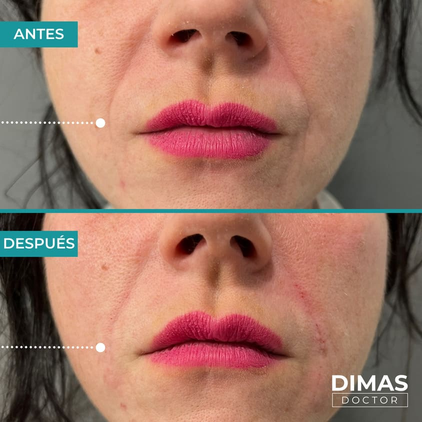 Arrugas Profundas170