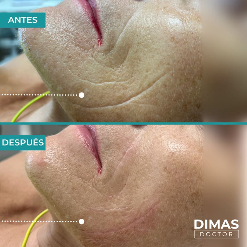 Arrugas Profundas232