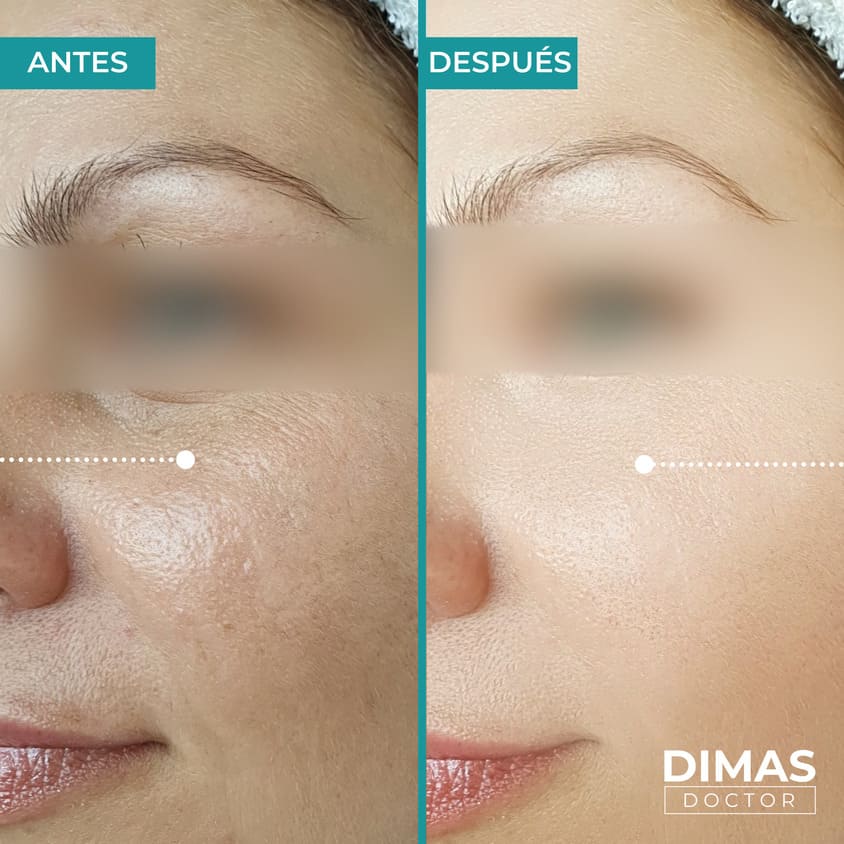 Skin booster biorevitalization212