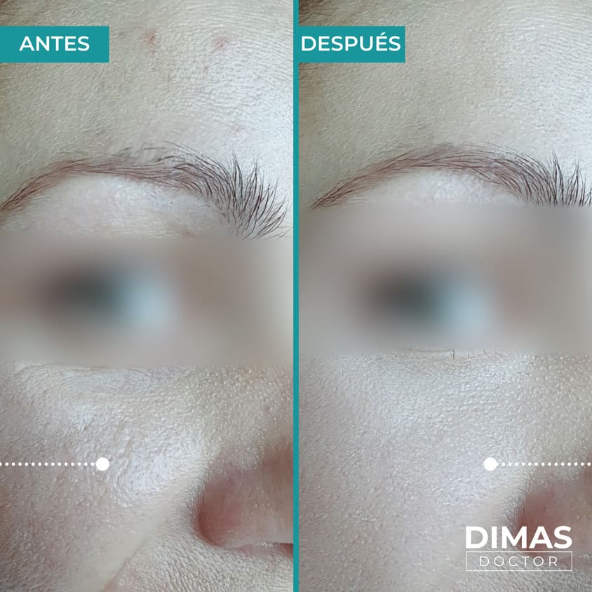 Skin booster biorevitalization213