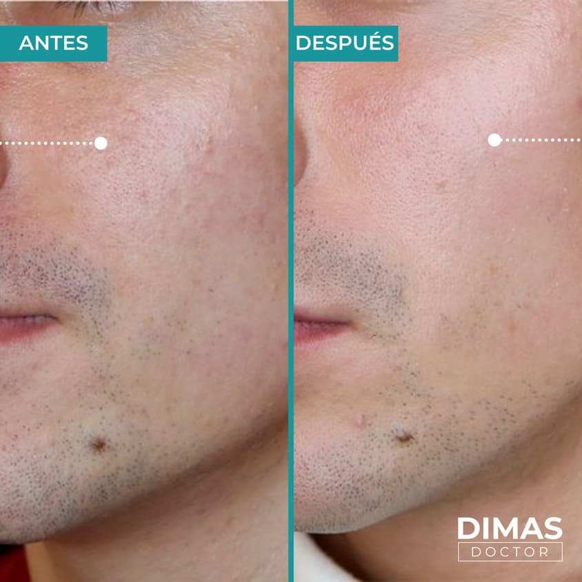 Skin booster biorevitalization215