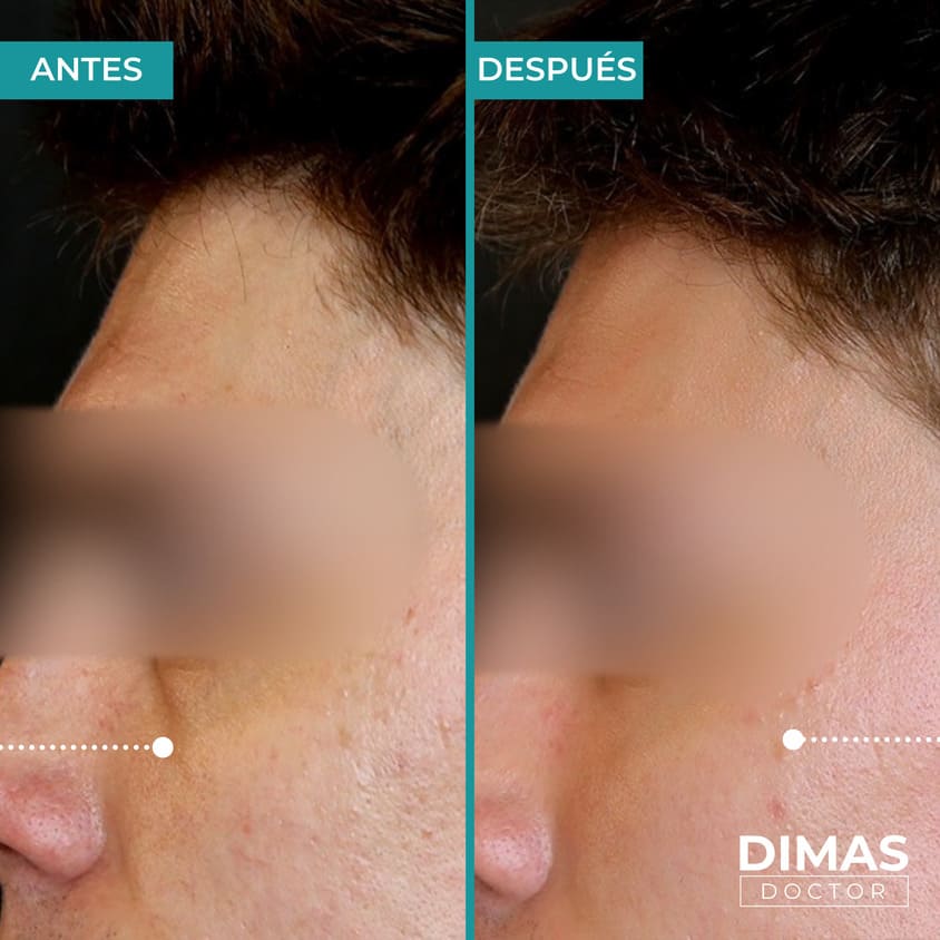 Skin booster biorevitalization216