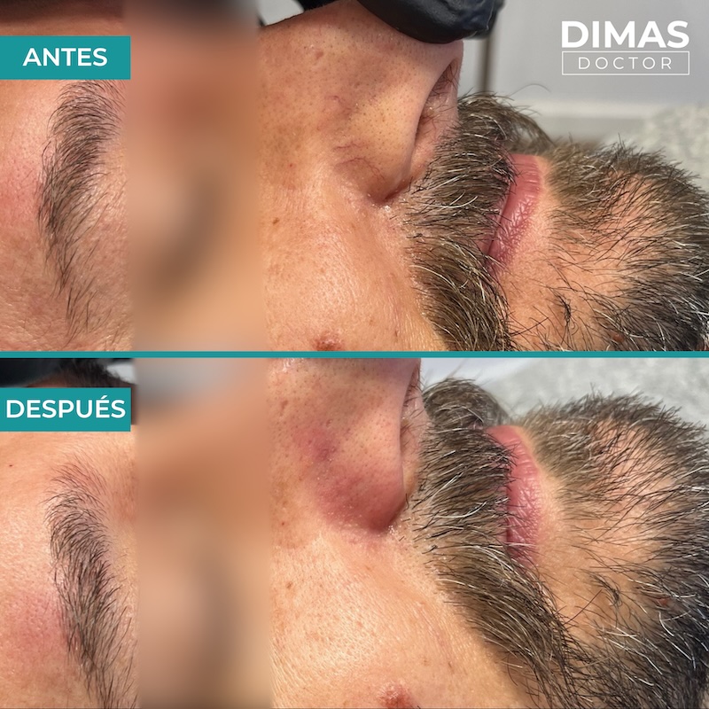 Antes y después tratamiento IPL para capilares y venas en la nariz