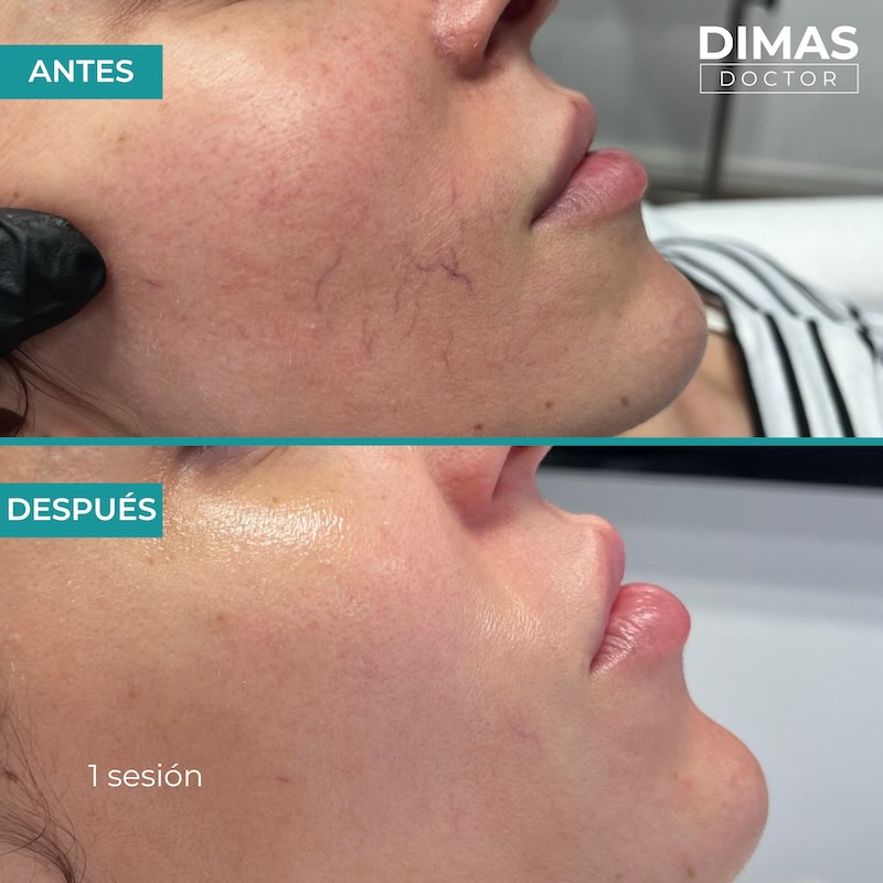 Antes y después tratamiento IPL para capilares y venas en la cara