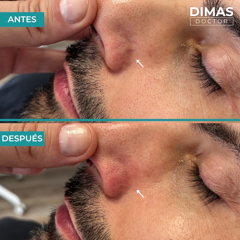 Antes y después tratamiento IPL para capilares y venas en la nariz