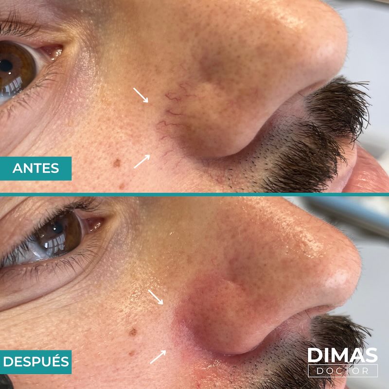 Antes y después tratamiento IPL para capilares y venas en la nariz