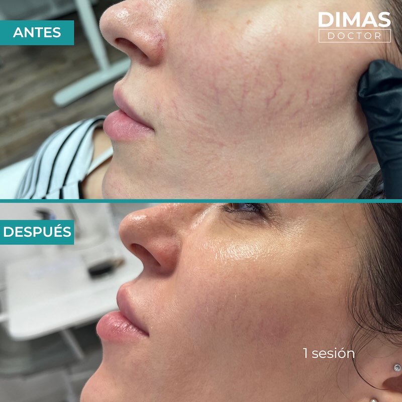 Antes y después tratamiento IPL para capilares y venas en la cara