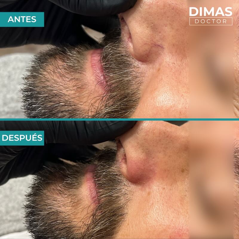 Antes y después tratamiento IPL para capilares y venas en la nariz