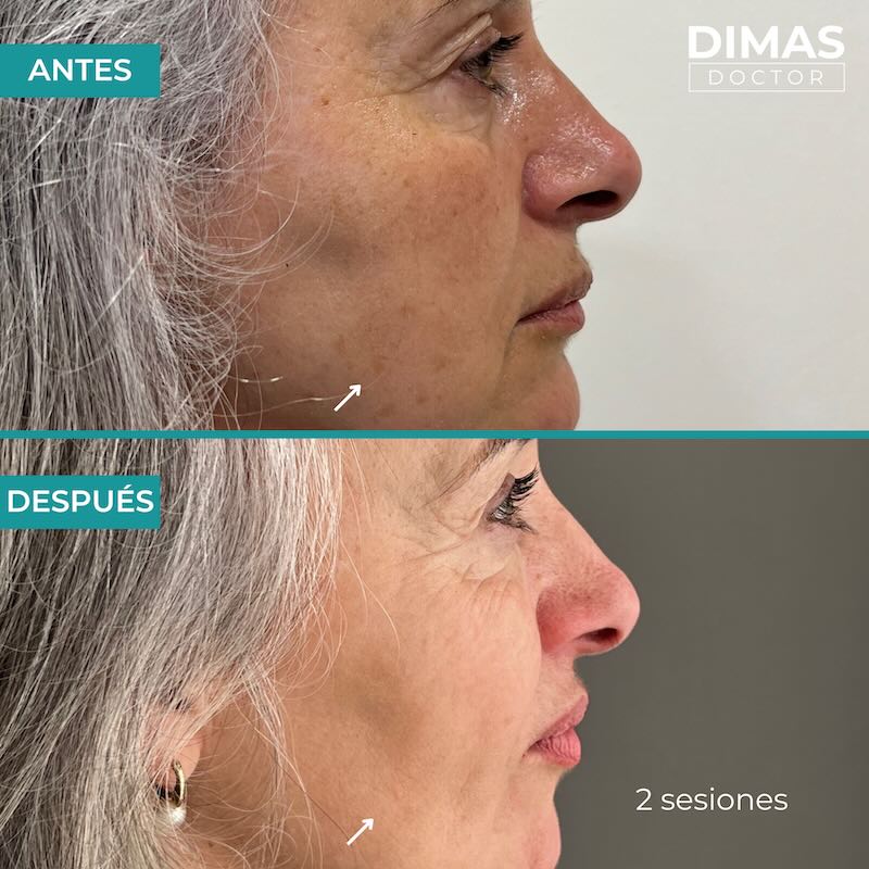 Antes y después tratamiento IPL para manchas en la cara