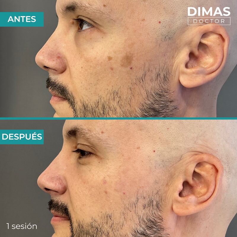 Antes y después tratamiento IPL para manchas en la cara