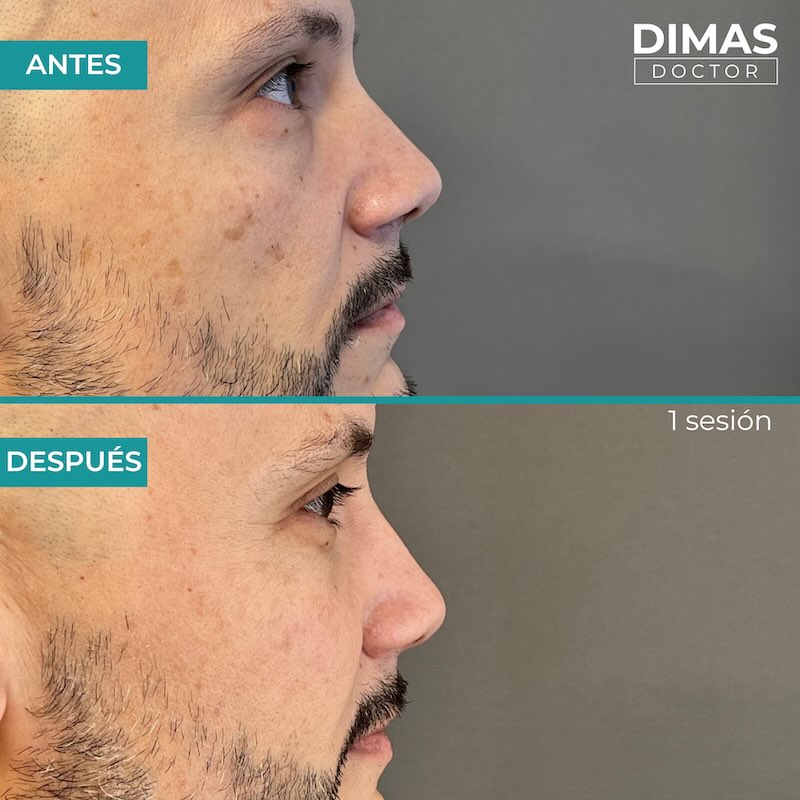 Antes y después tratamiento IPL para manchas en la cara