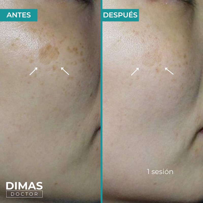 Antes y después tratamiento IPL para manchas en la cara