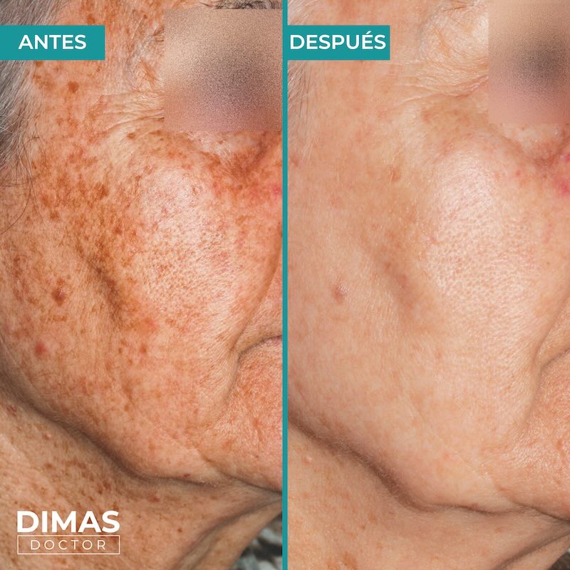 Antes y después tratamiento IPL para manchas en la cara