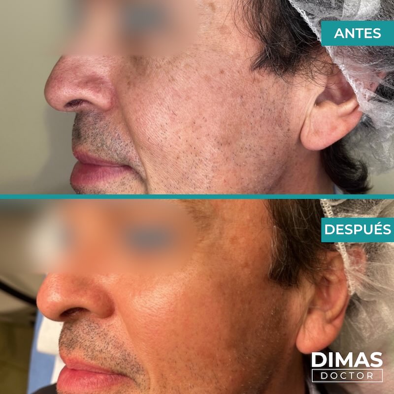 Antes y después tratamiento IPL para manchas en la cara