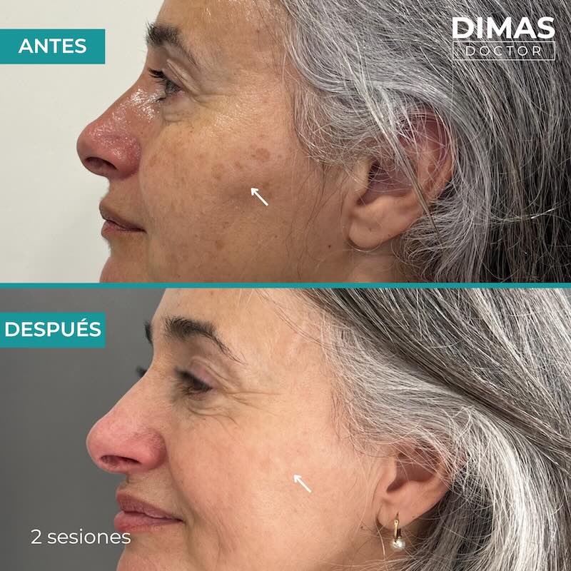 Antes y después tratamiento IPL para manchas en la cara