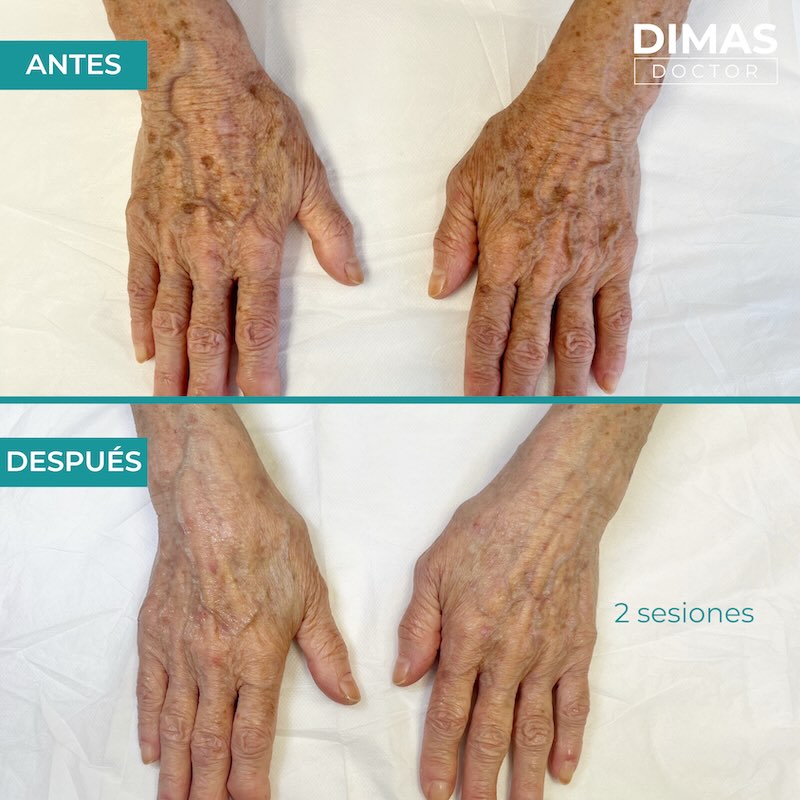 Antes y después tratamiento IPL para manos
