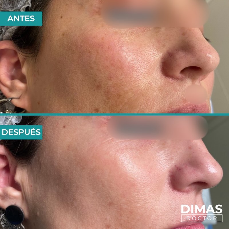 Antes y después tratamiento IPL para manchas en la cara