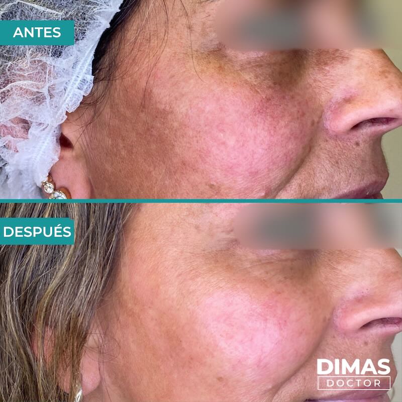 Antes y después tratamiento IPL para rojeces en la cara