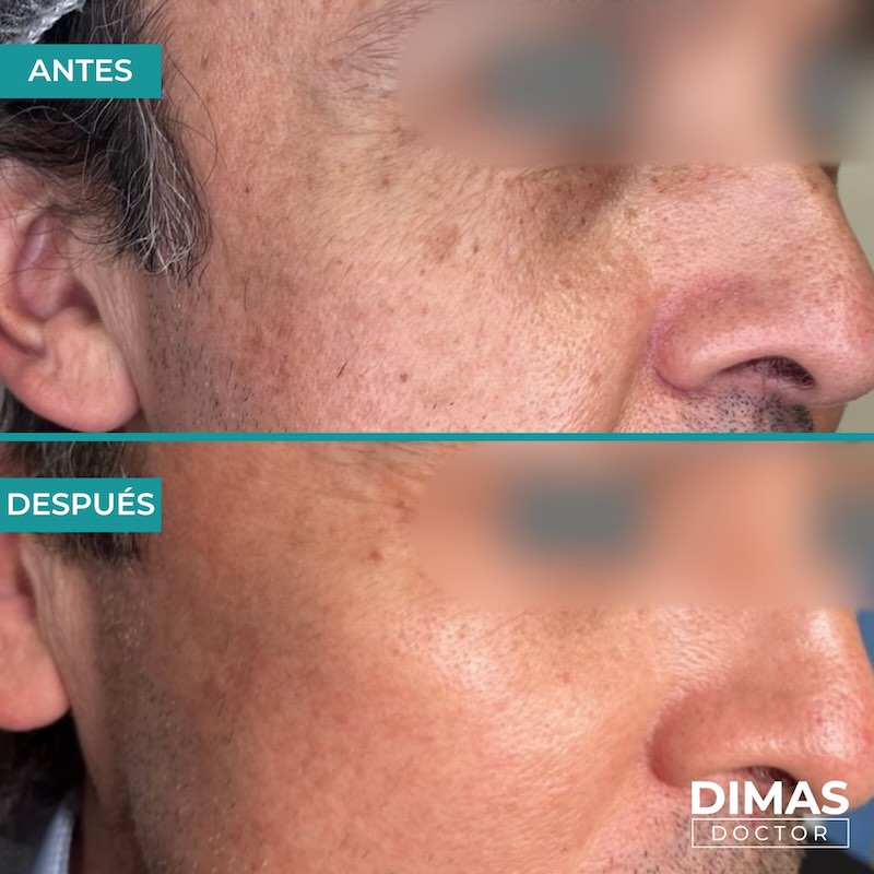 Antes y después tratamiento IPL para manchas en la cara