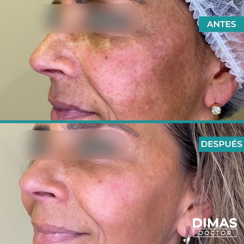 Antes y después tratamiento IPL para rojeces en la cara