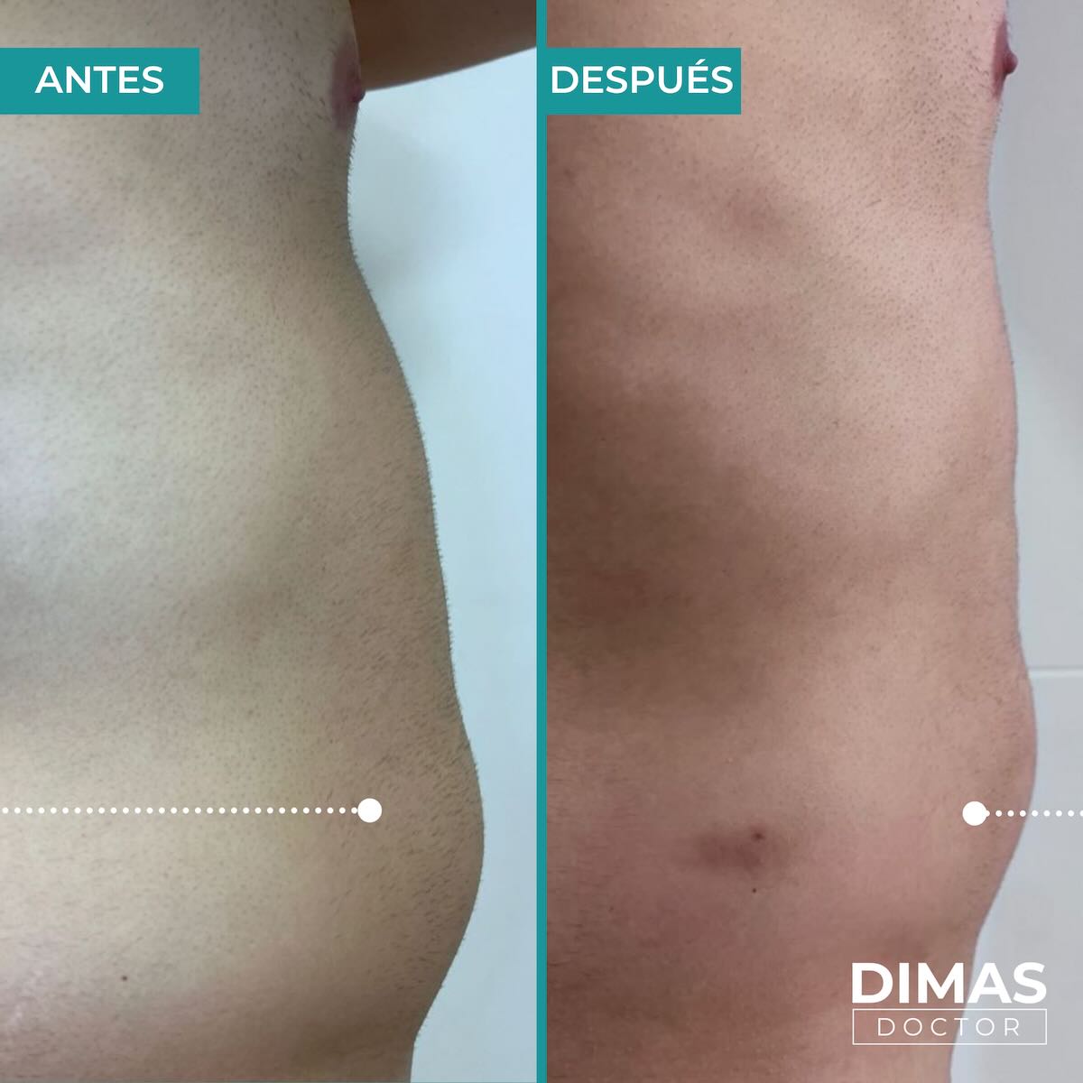 Lifting en la barriga sin cirugía con Ultraformer MPT