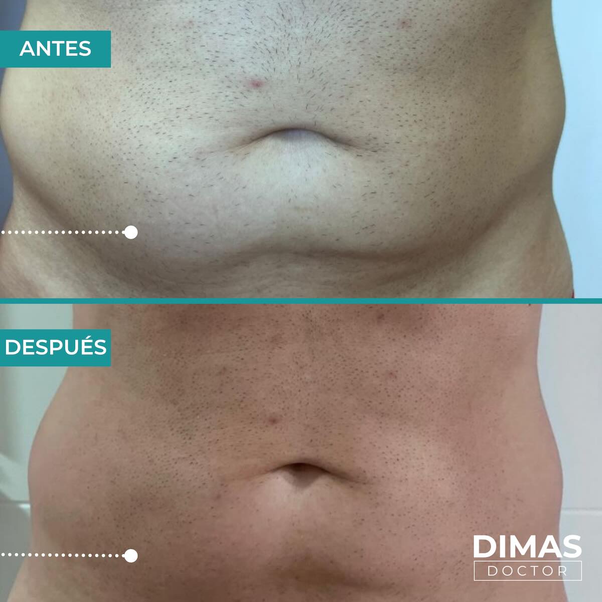 Lifting en la barriga sin cirugía con Ultraformer MPT