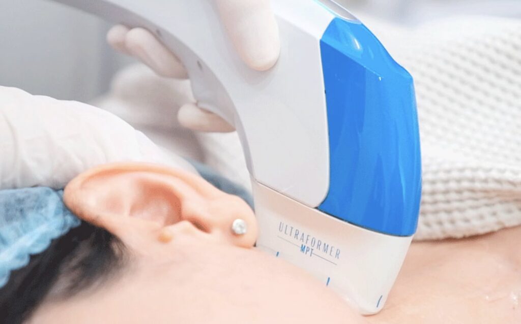 Lifting sin cirugía en cuello con Ultraformer MPT