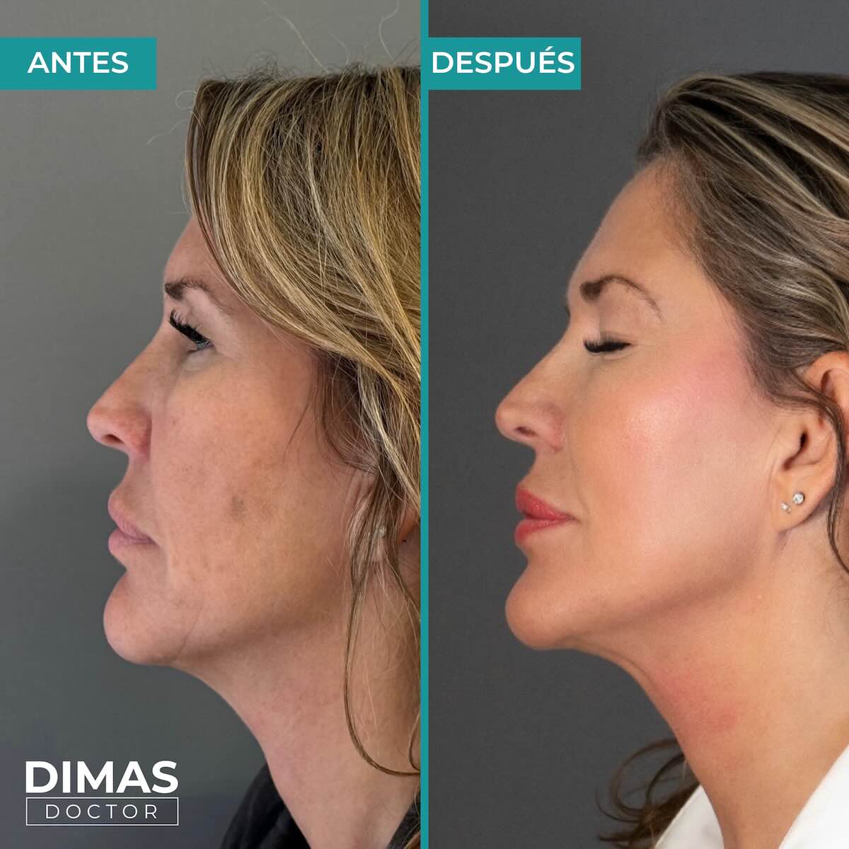 Lifting sobre el rostro sin cirugía con Ultraformer MPT