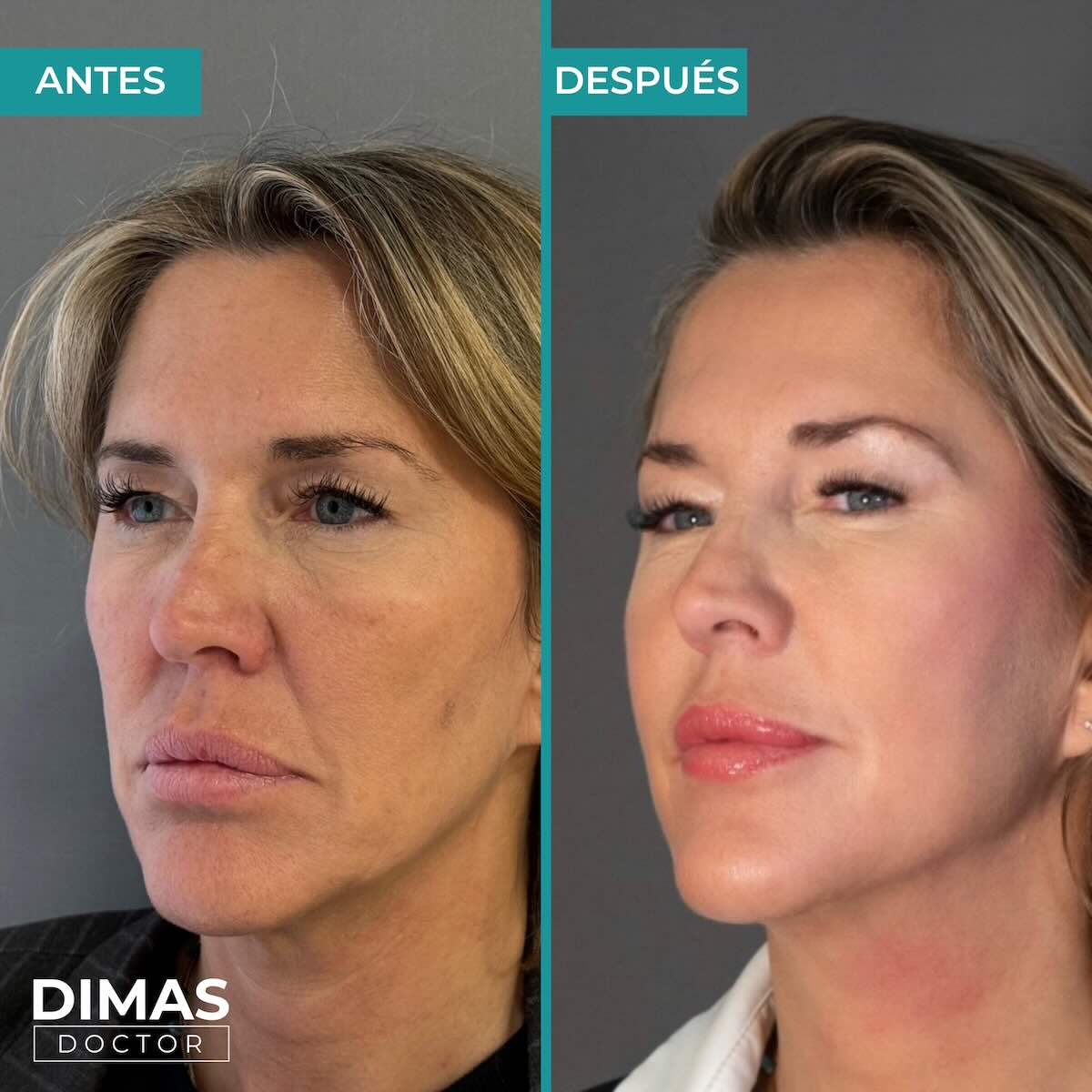 Lifting sobre la cara sin cirugía con Ultraformer MPT