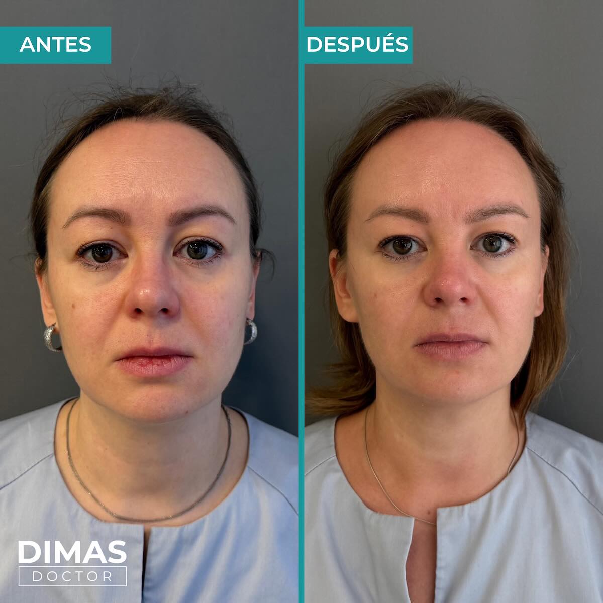 Lifting facial sin cirugía con Ultraformer MPT