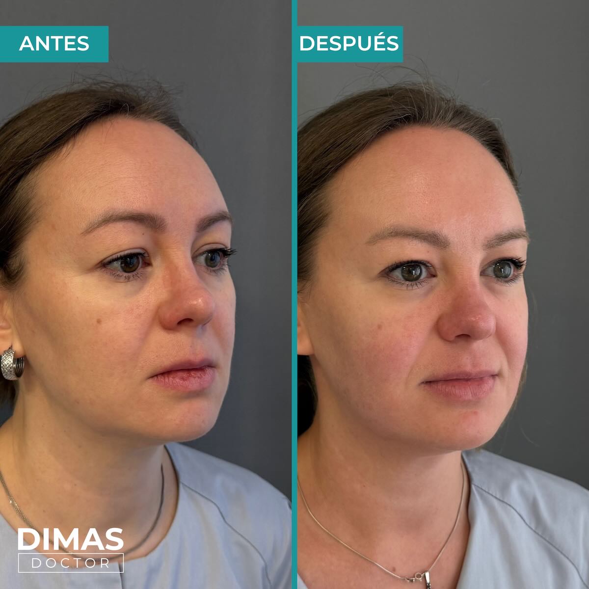 Lifting facial sin cirugía con Ultraformer MPT