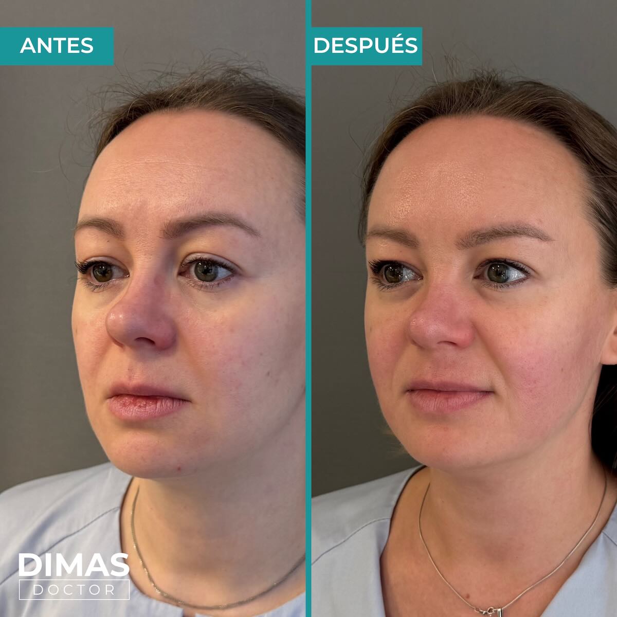 Lifting facial sin cirugía con Ultraformer MPT