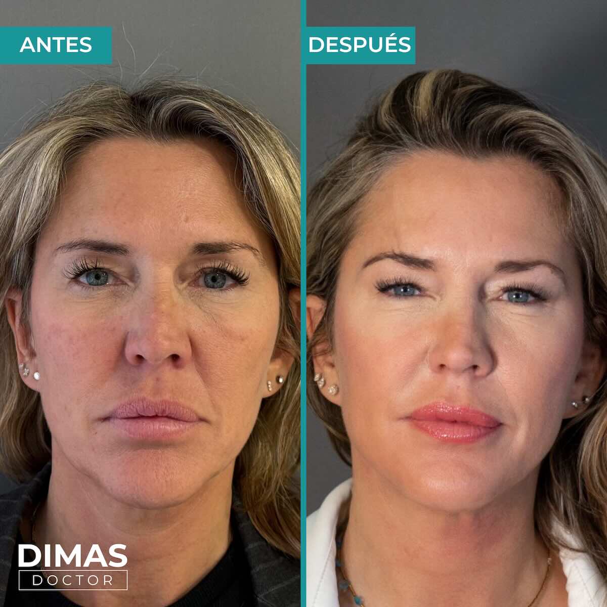 Lifting sobre el rostro sin cirugía con Ultraformer MPT