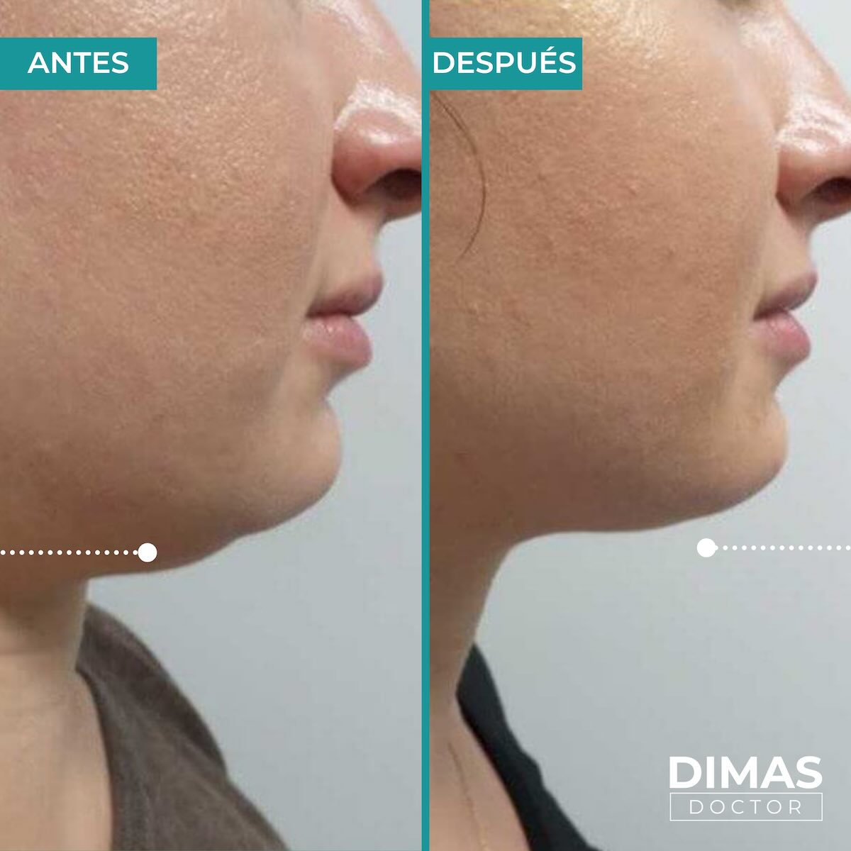 Lifting sin cirugía en papada con Ultraformer MPT