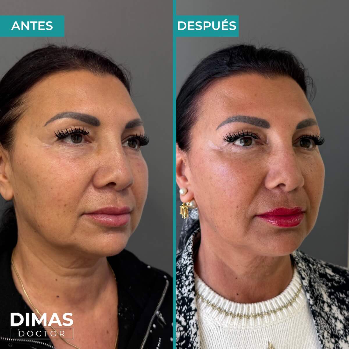 Lifting sobre el rostro sin cirugía con Ultraformer MPT
