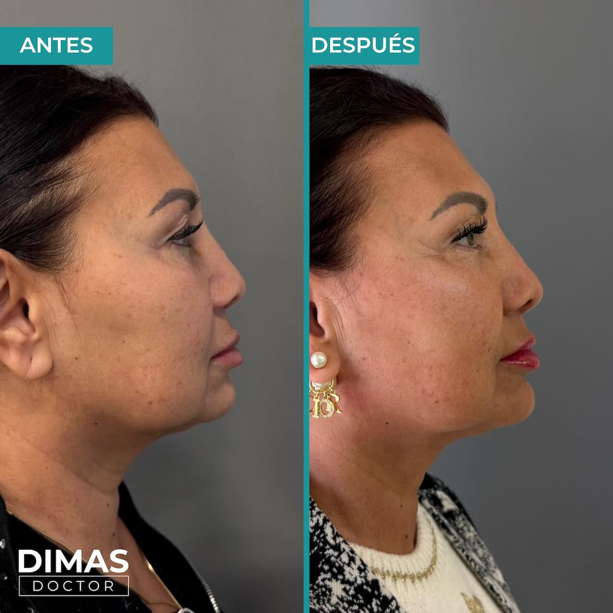 Lifting sobre el rostro sin cirugía con Ultraformer MPT
