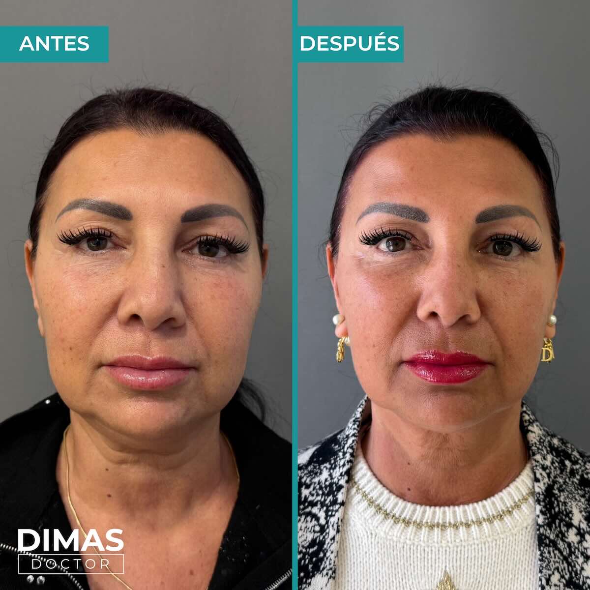 lifting-sin-cirugia-rostro-ultraformer-mpt3