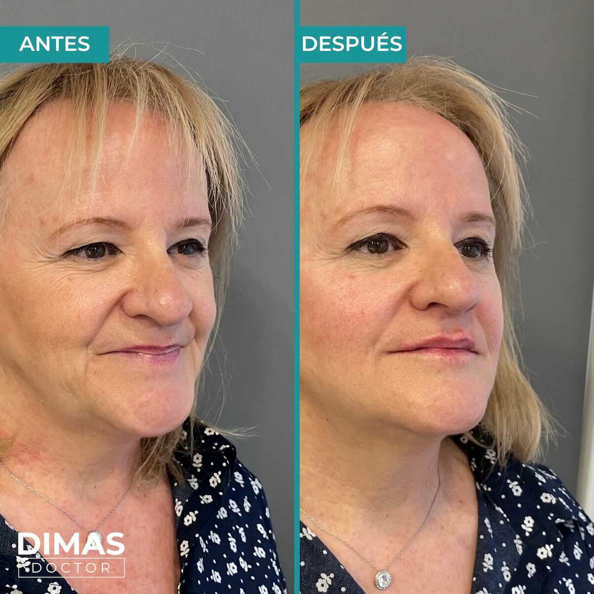 Armonización facial en rostro de mujer en Barcelona