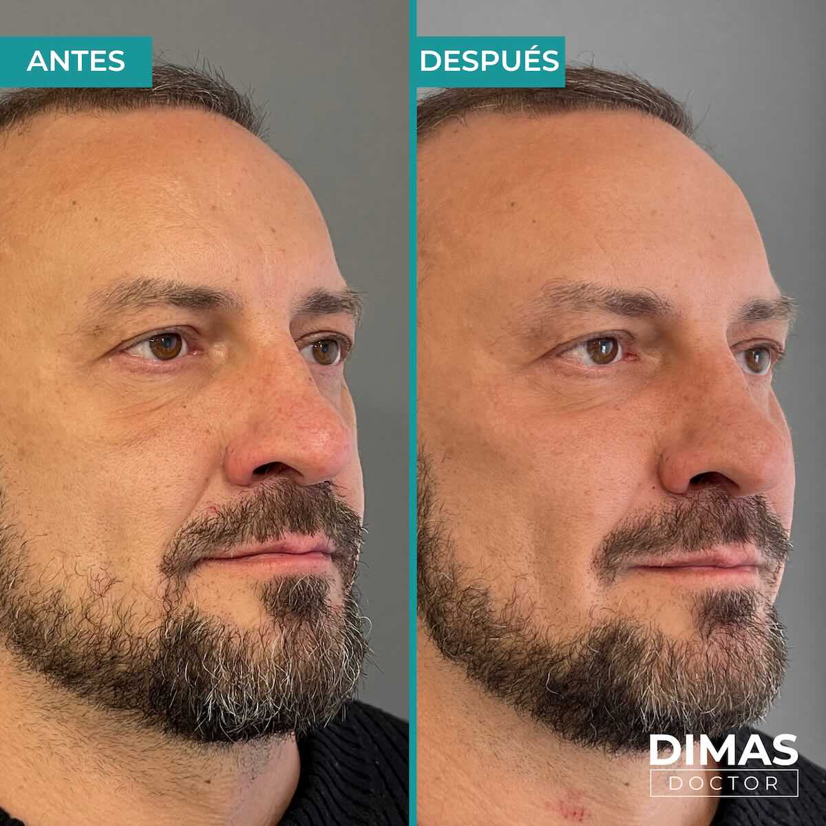 Armonización facial en rostro de hombre en Barcelona