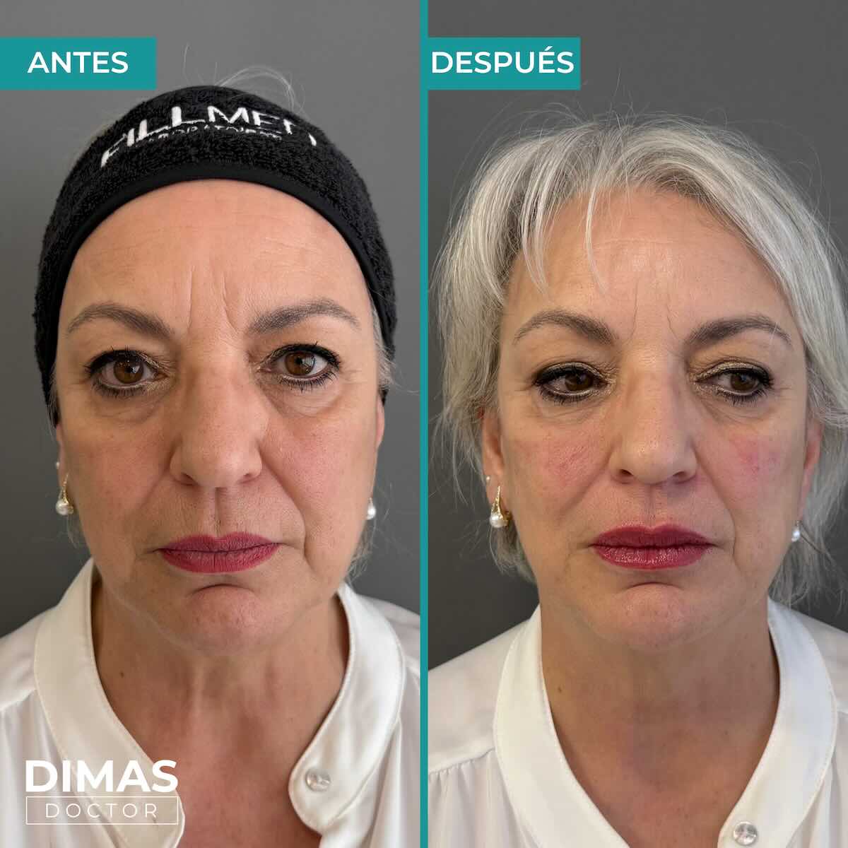 Armonización facial en rostro de mujer en Barcelona