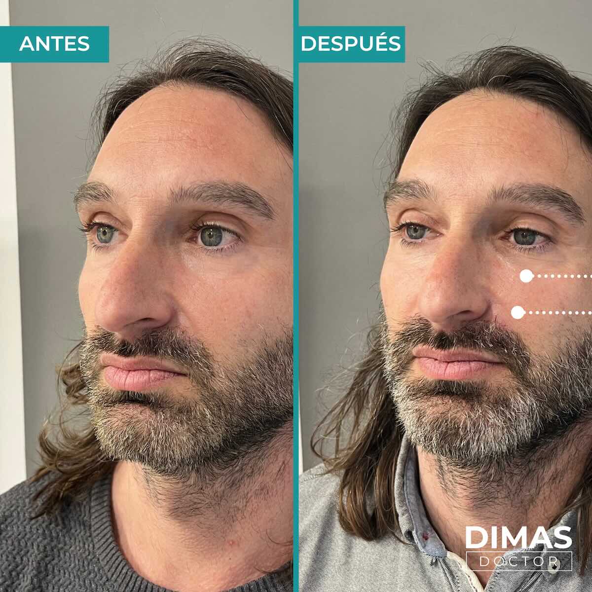 Armonización facial en rostro de hombre en Barcelona