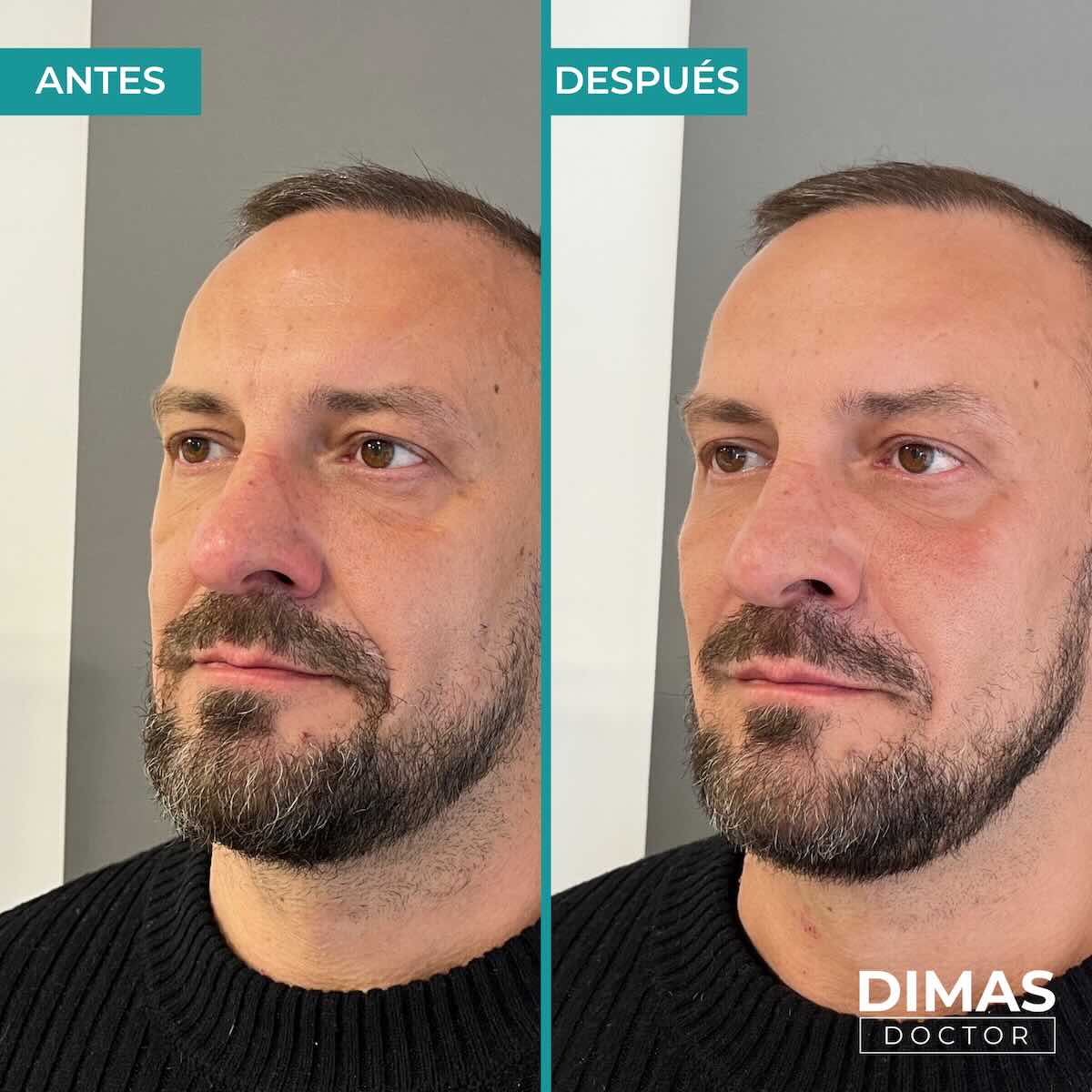 Armonización facial en rostro de hombre en Barcelona