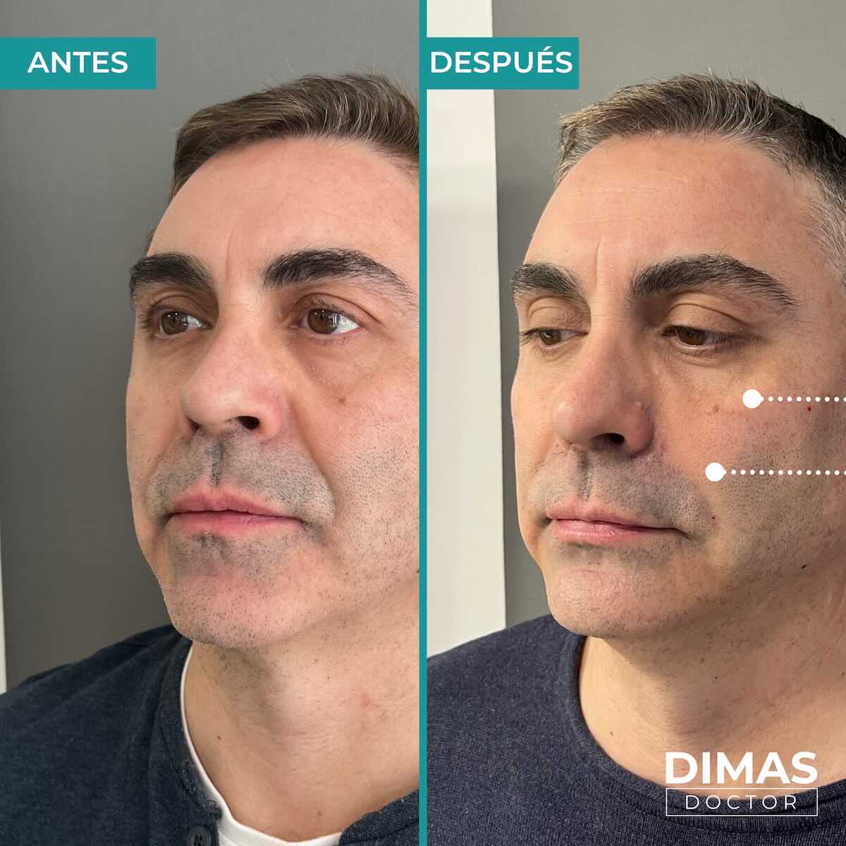 Armonización facial en rostro de hombre en Barcelona