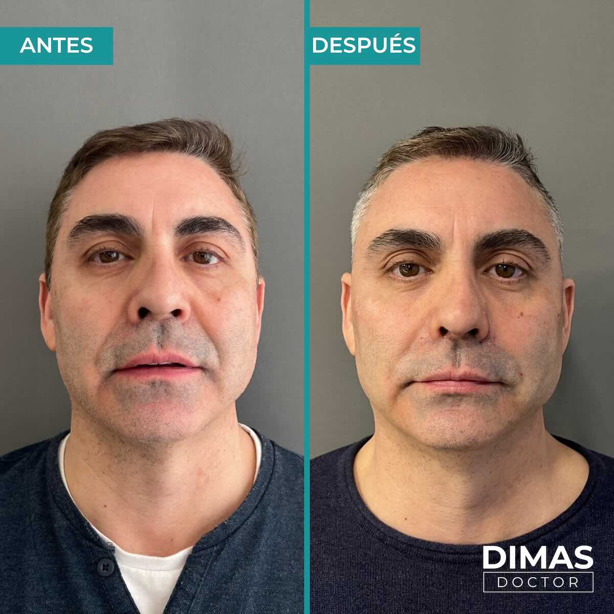 Armonización facial en rostro de hombre en Barcelona