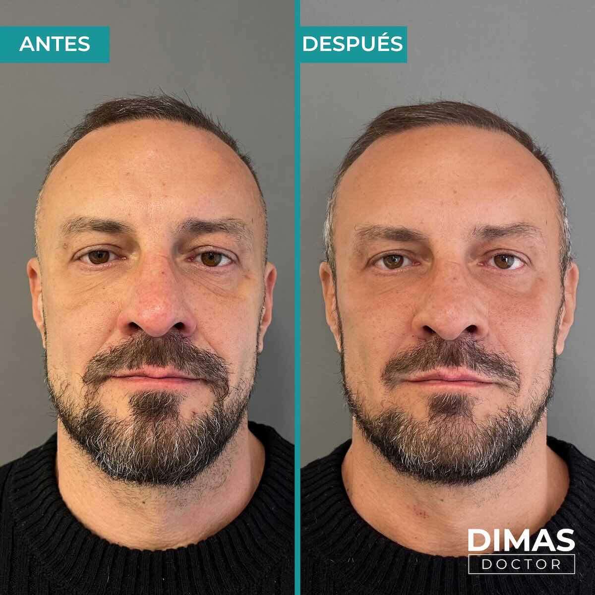 Armonización facial en rostro de hombre en Barcelona