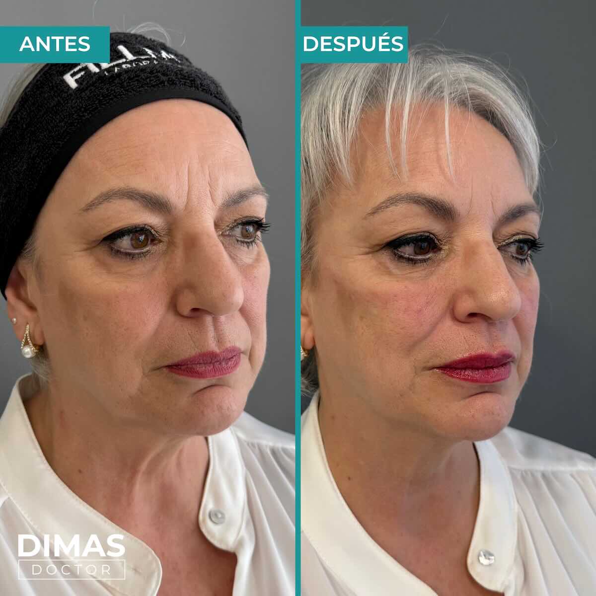 Armonización facial en rostro de mujer en Barcelona