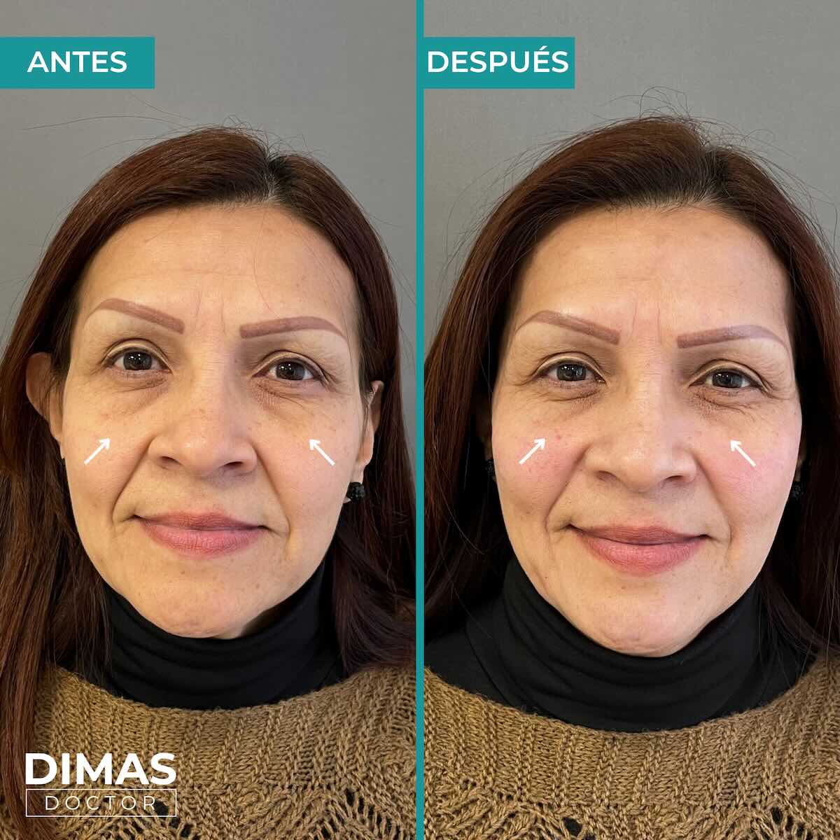 Armonización facial en rostro de mujer en Barcelona