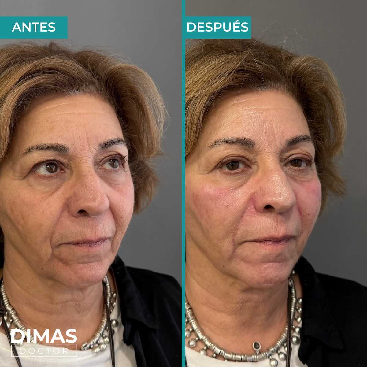 Armonización facial en rostro de mujer en Barcelona