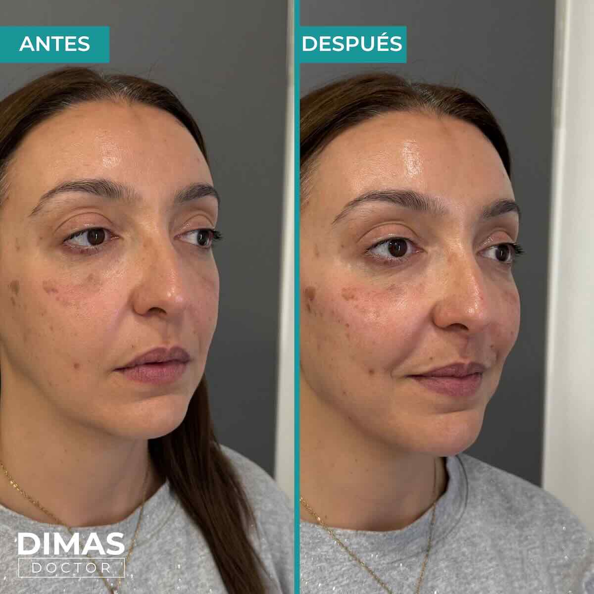 Armonización facial en rostro de mujer en Barcelona