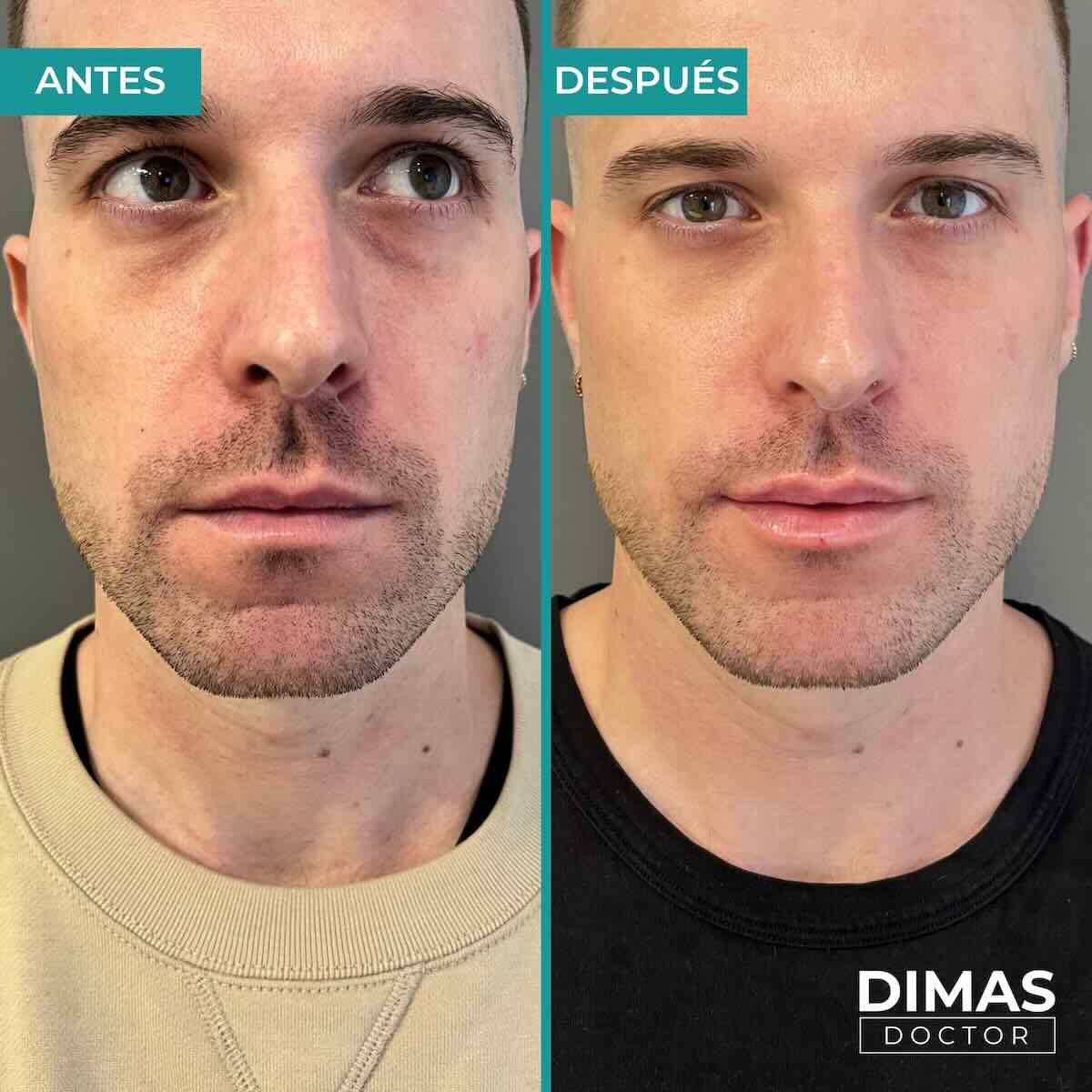 Armonización facial en rostro de hombre en Barcelona